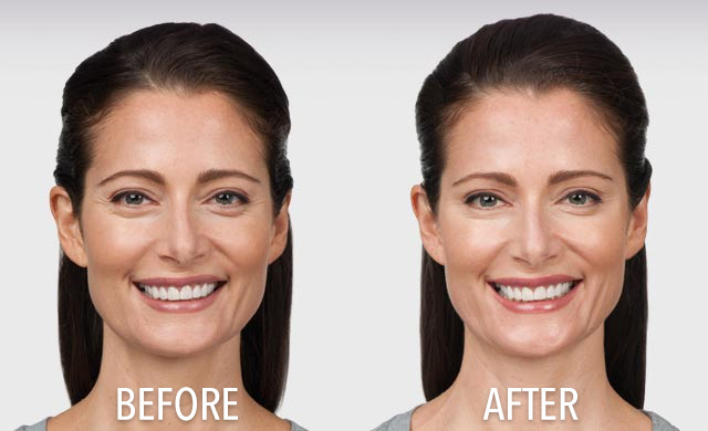 Patient Botox Transformation