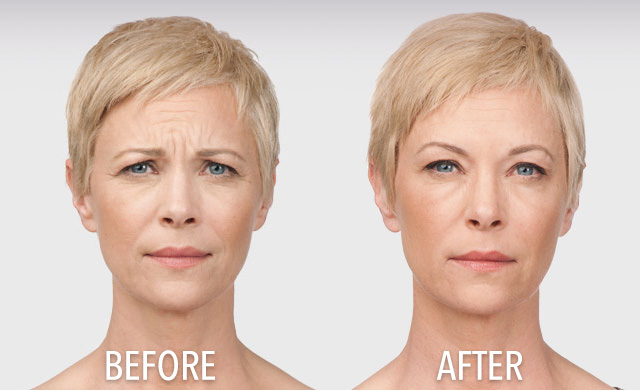 Botox Patient Transformation