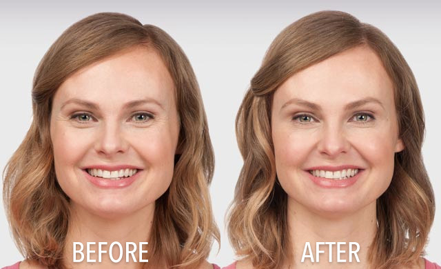 South Holland, IL Botox Transformation