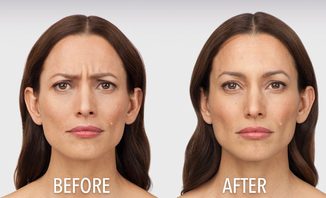 Remove Wrinkles with Botox